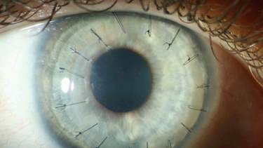Keratitis durch Kontaktlinsen | Bild: BR