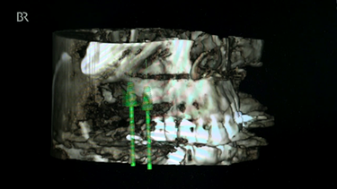 Röntgenbild von zwei Zahnimplantaten | Bild: BR