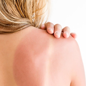 Eine Frau hat einen leichten Sonnenbrand auf dem Rücken. | Bild: BR/ORF/ORF III/Michael Dalpiaz