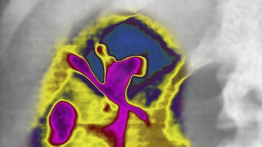 Polyzystische Niere, visualisiert durch Urographie. Dadurch ergeben sich lila Flecken auf gelbem Grund. | Bild: picture-alliance/dpa