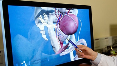 Schematische Darstellung einer Prostata auf einem Computerbildschirm | Bild: picture-alliance/dpa