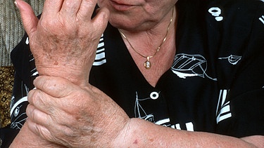 Frau hält sich arthritisches Handgelenk | Bild: picture-alliance/dpa