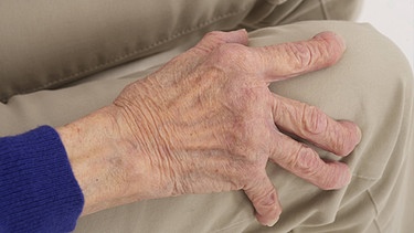 arthritische Hand einer älteren Frau | Bild: picture-alliance/dpa
