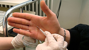 Typisch für ein Ekzem sind: Rötung, Schwellung, Bläschenbildung. Im Bild: Untersuchung einer Hand mit Ekzem beim Hautarzt. | Bild: picture-alliance/dpa