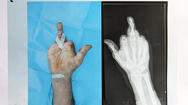 Auch richtig schlimme Verletzungen gehören zur Arbeit von Handchirurgen, so bei Amputationen und Verpflanzungen. Im Bild Hand eines Mannes, dem sämtliche Finger aufgrund eines Unfalls amputiert wurden und der nun einen Zehen an die Hand verpflanzt bekommen hat. | Bild: picture-alliance/dpa