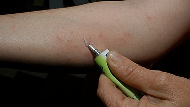 Sowohl bei Kontaktallergien als auch bei Sofort-Typ Allergien spielt Cortison eine große Rolle. Im Bild: Eine Frau mit Allergie schmiert sich Arm mit Salbe ein. | Bild: colourbox.com