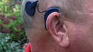 Cochlea Implantat | Bild: picture-alliance/dpa
