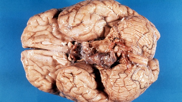 Ein menschliches Gehirn ohne pathologischen Befund | Bild: picture-alliance/dpa
