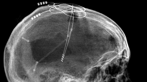 Verlauf von Elektroden im Schädel eines Mannes, mit Hilfe derer er wieder sprechen und essen kann | Bild: picture-alliance/dpa