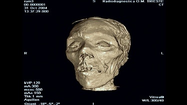Die Röngtenaufnahme einer Mumie | Bild: BR