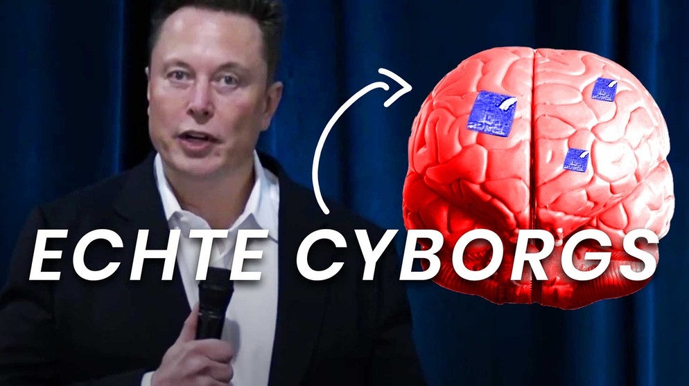 Elon Musk träumt davon, dass wir bald alle Elektroden im Hirn haben - und so mit künstlichen Intelligenzen mithalten können. Aber ist das realistisch? Wo BCIs in der Medizin heute schon eingesetzt werden und wo die Grenzen der "Gehirnchips" liegen. | Bild: BR