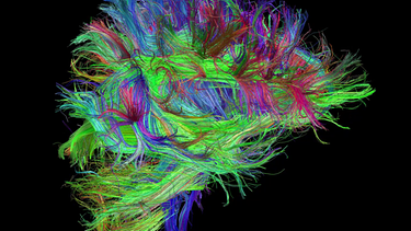 Demenz: Was macht das Gehirn krank? | Bild: Deutsches Zentrum für Neurodegenerative Erkrankungen, DZNE