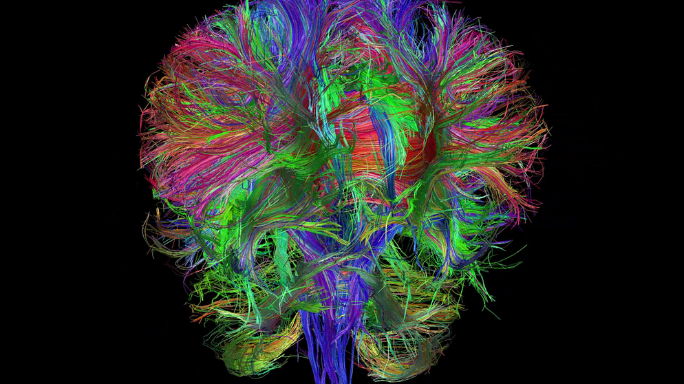 Demenz: Was macht das Gehirn krank? | Bild: Deutsches Zentrum für Neurodegenerative Erkrankungen, DZNE