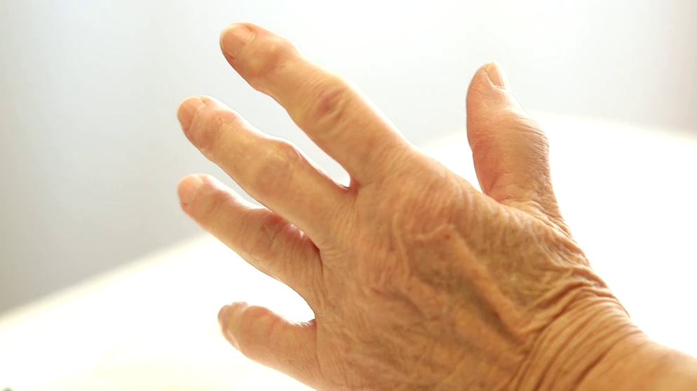 Was hilft bei Nervenschmerzen Hand?
