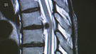 Bei einem Bandscheibenvorfall kann auch die Brustwirbelsäule betroffen sien, wie hier auf dem Röntgenbild zu sehen  | Bild: BR