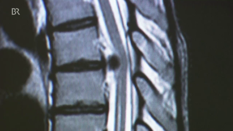 Bei einem Bandscheibenvorfall kann auch die Brustwirbelsäule betroffen sien, wie hier auf dem Röntgenbild zu sehen  | Bild: BR