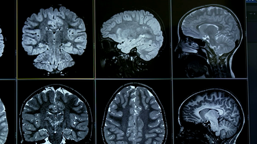 Gehirn im MRT | Bild: BR