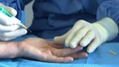 Operation an einer Hand | Bild: Bayerischer Rundfunk