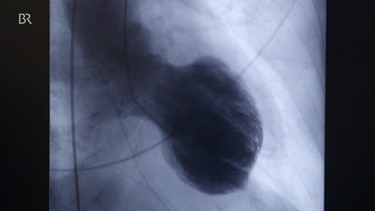Röntgenaufnahme: Ballonartig aufgeblähtes Herz | Bild: BR