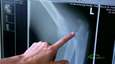 Röntgenaufnahme ein schwerer Bruch | Bild: Screenshot BR