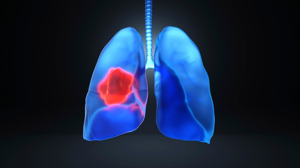 Digitale Darstellung von Lungenkrebs | Bild: picture-alliance/dpa