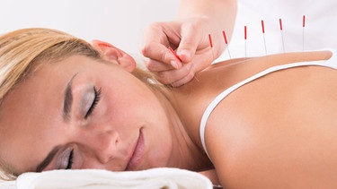 Nahaufnahme der Hand der Durchführung der Akupunktur-Therapie  | Bild: picture-alliance/dpa