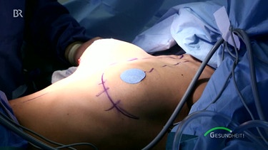 Brust-Vergrößerung: Hier wird das Implantat unter dem Brustmuskel platziert. | Bild: Screenshot BR