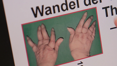 Deformation an den Händen bei Rheuma-Patienten vor etwa 25 Jahren  | Bild: BR