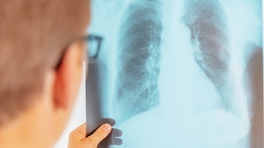 Tuberkulose | Bild: colourbox.com