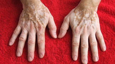 Vitiligo: Weißfleckenkrankheit | Bild: picture alliance / dpa-mag | Georg Pliszewski