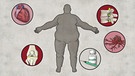 Grafik: Welche gesundheitlichen Folgen Adipositas für den Körper haben kann. | Bild: BR