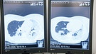 Spuen in der Lunge nach einer Covid-19 Erkrankung. Weiße Eintrübungen weisen auf eine Entzündung der Lunge hin.  | Bild: BR/Gut zu wissen