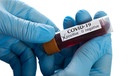 Positiver Test auf das Corona-Virus Covid19 | Bild: colourbox.com