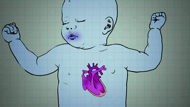 Angeborene Herzfehler: Leben mit einem Einkammerherz | Bild: BR