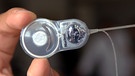 Cochlea Implantat | Bild: picture-alliance/ dpa/dpaweb