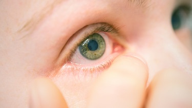 Symbolbild Augenentzündung | Bild: picture-alliance/dpa/Karo Kraemer