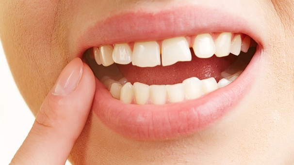 Frau mit schmerzhafter Zahnfleischentzündung im Mund hält Finger an Zahn | Bild: picture alliance / Zoonar | Robert Kneschke