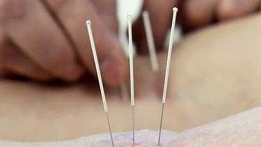 Akupunktur ist das wohl bekannteste Heilverfahren der traditionellen chinesischen Medizin. Placebo oder tatsächlich wirksam? Wir wollen es herausfinden. Tim Berendonk beweist Mut und lässt sich für den NDR WissensCheck piksen | Bild: NDR