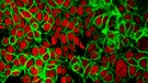 Forscher im Midwest Cancer Nanotechnology Training Center (M-CNTC) haben neue Medikamente für die Krebstherapie entwickelt. Das Bild zeigt, wie Mikropartikel des Medikamentes sich an den noch kleineren Mikrofasern der Krebszellen festsetzen. | Bild: picture alliance / BSIP | NIH / IMAGE POINT FR