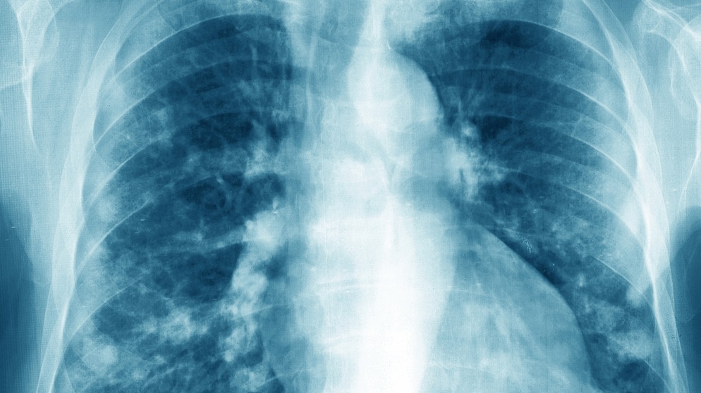 Pulmonary metastases (secondary to kidney cancer), visualized by a frontal chest X-ray. | Bild: picture alliance / BSIP | CAVALLINI JAMES