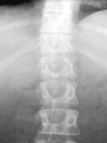 Röntgenbild einer Wirbelsäule (Symbolbild) | Bild: picture-alliance/dpa