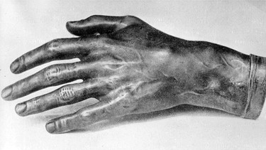 Ein Abguss der linken Hand des Komponisten und Pianisten Frédéric Chopin. | Bild: picture alliance / IMAGNO/Votava