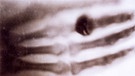 Das erste veröffentlichte Röntgenbild der Welt: die Hand von Bertha Röntgen, Ehefrau von Wilhelm Conrad Röntgen. | Bild: Sammlung Nachlass Wilhelm Conrad Röntgen, Deutsches Röntgen-Museum, Remscheid