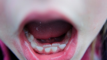 Kind mit geöffnetem Mund: Hinter den Milchschneidezähnen sind schon die bleibenden Zähne durchgebrochen. Ein sogenanntes "Haifischgebiss". | Bild: colourbox.com