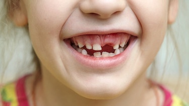 Mädchen lacht in die Kamera: Man sieht ihr Wechselgebiss aus Milchzähnen und bleibenden Zähnen. | Bild: colourbox.com