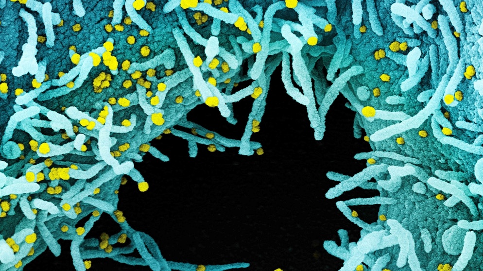 Vom Corona-Virus attackierte Zellen eines menschlichen Körpers unter dem Mikroskop | Bild: picture-alliance/dpa