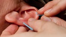 Ein Therapeut steckt der Patientin Akupunktur-Nadeln ins Ohr.  | Bild: picture-alliance/dpa