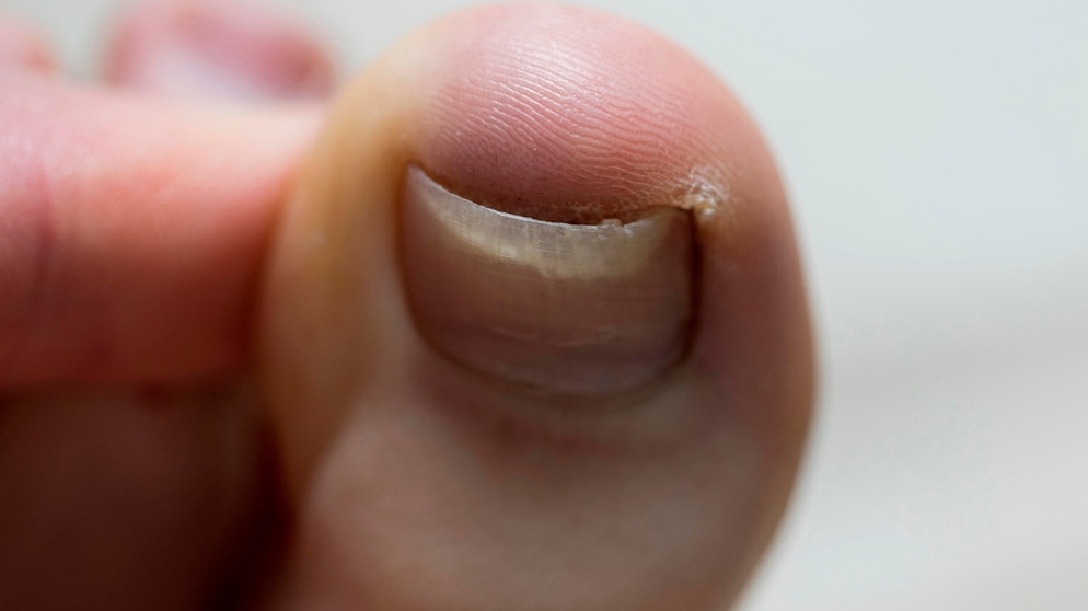 Unterm fingernagel eiter Nagelentzündung »