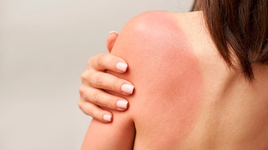 Eine Frau, man sieht sie nur von hinten, hat einen Sonnenbrand am Rücken | Bild: mauritius images