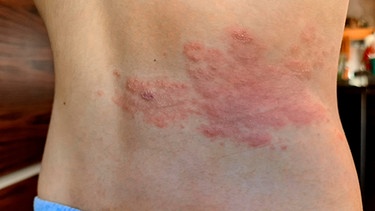 Mann mit Gürtelrose hat Schmerzen und hält sich den Rücken | Bild: dpa/picture alliance